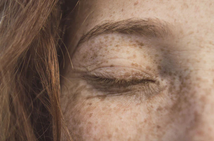 How Do I Remove Sun Spots After Summer