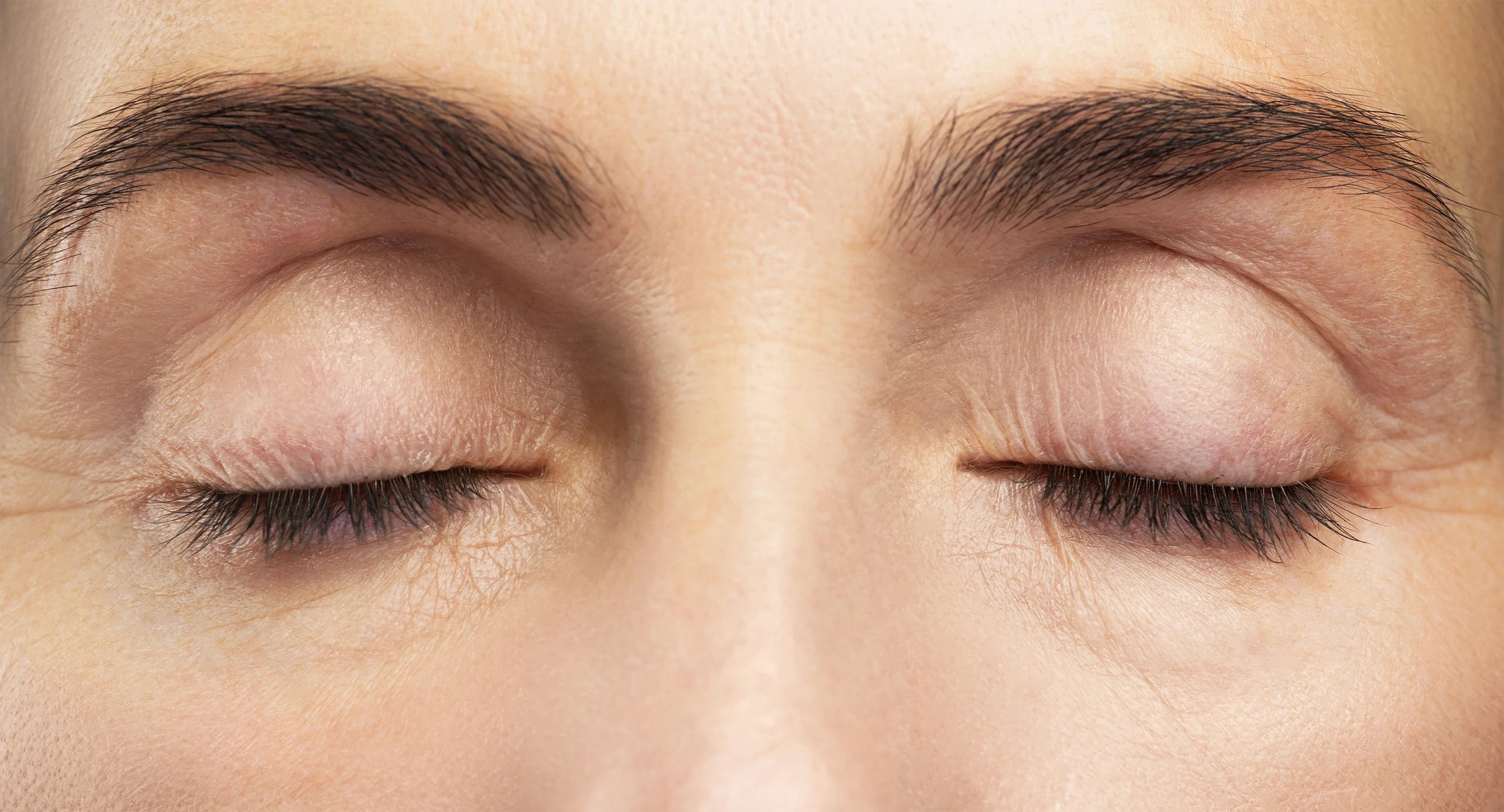 After treatment close-up of rejuvenated skin around the eye area with visibly reduced wrinkles and smoother texture.