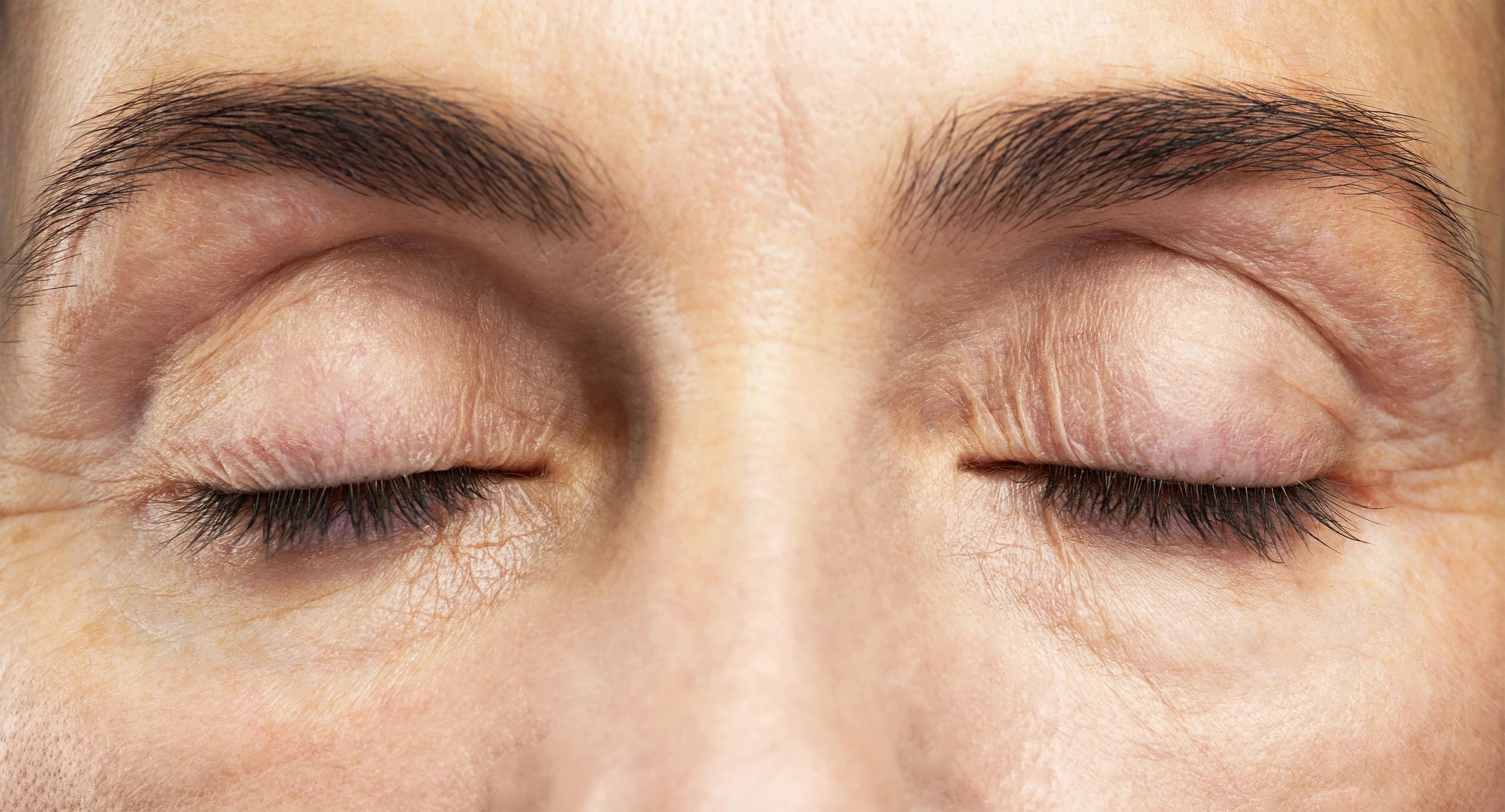 Before treatment close-up of aging skin around the eye area showing deep wrinkles and fine lines.