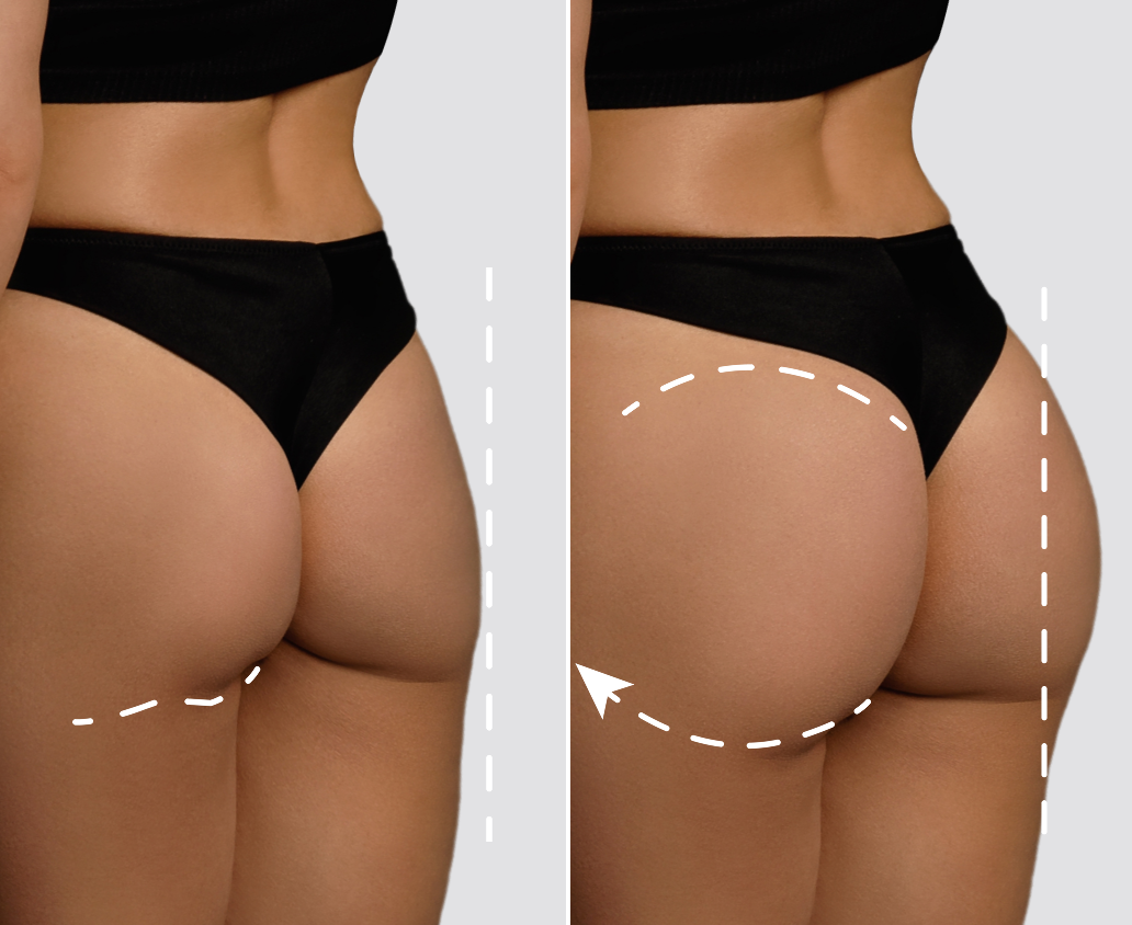 Anti-Sag Effect