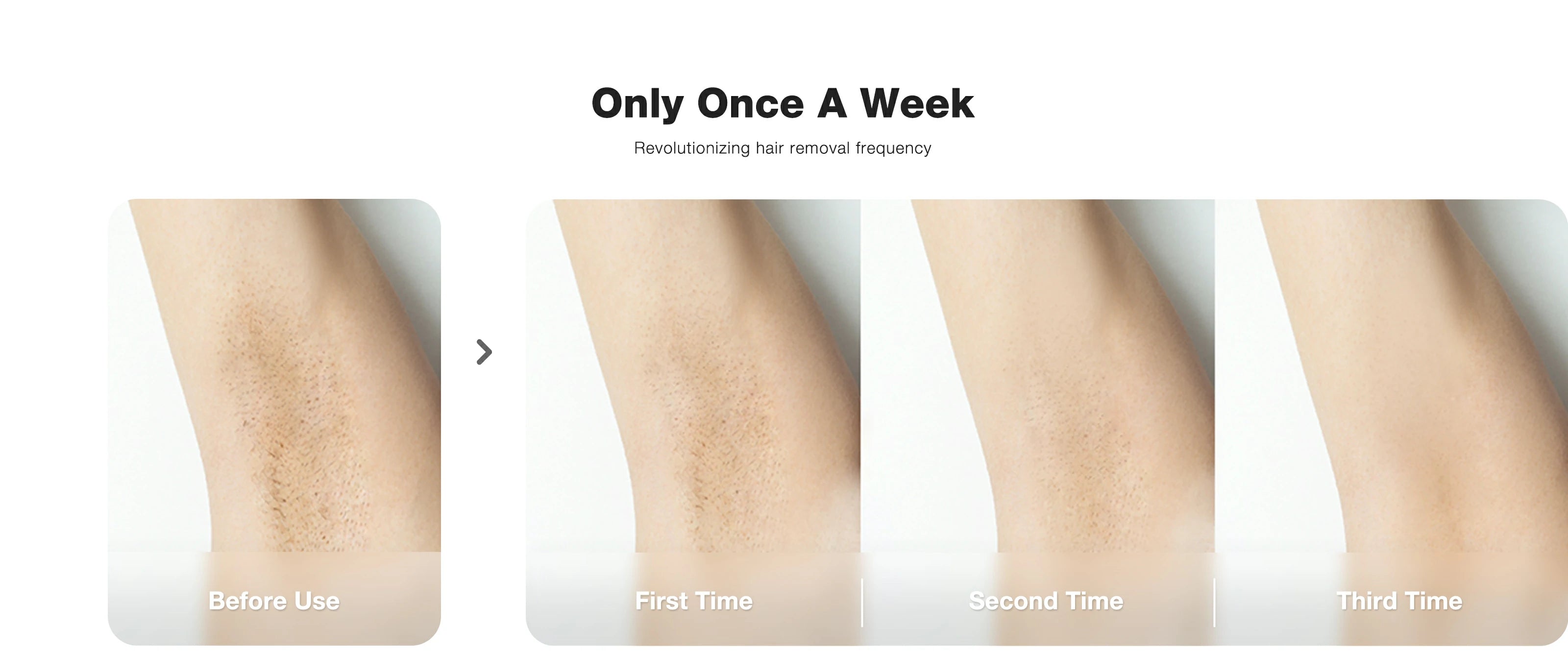 Sequential hair removal results with JOVS X™, from before use, and after first, second, and third weekly treatments, showing diminishing hair presence.