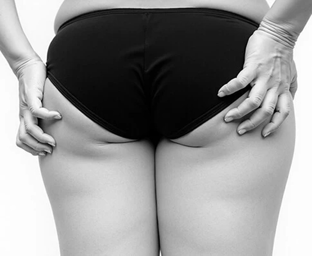 Flat or weak glutes fromprolonged sitting