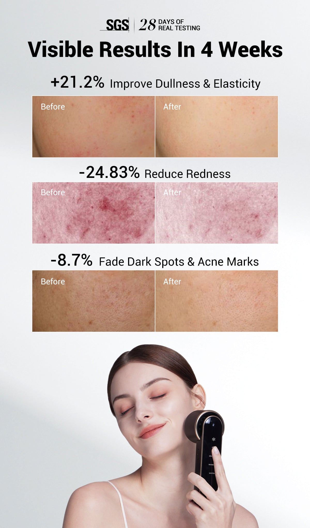 JOVS Blacken Photofacial Device showing visible results in 4 weeks, reducing redness and dark spots while improving skin's dullness and elasticity.