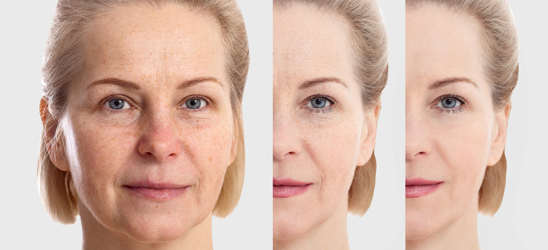 LED vs Laser for Skin Rejuvenation: What's the Difference?
