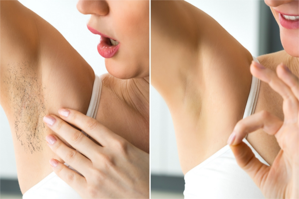 Best IPL Hair Removal Devices 2023: Say Goodbye to Unwanted Hair Forever!