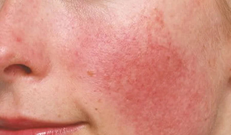 facial redness