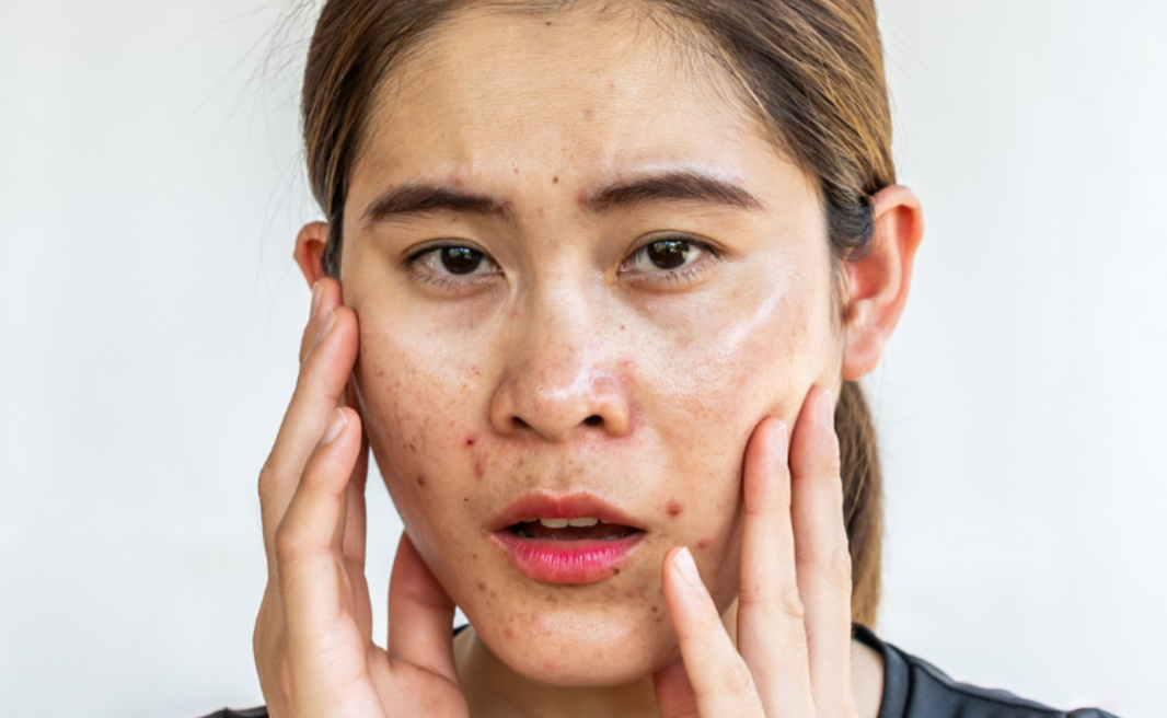 Best Skincare Routine for Oily Skin