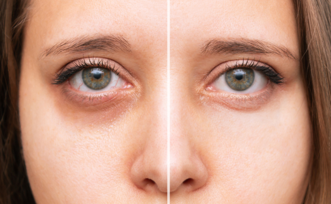 How to Remove Dark Circles Under Eyes