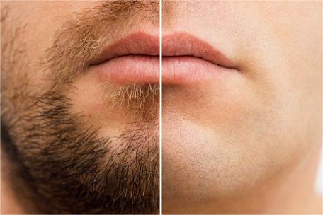 Permanent Hair Removal Ways for Men
