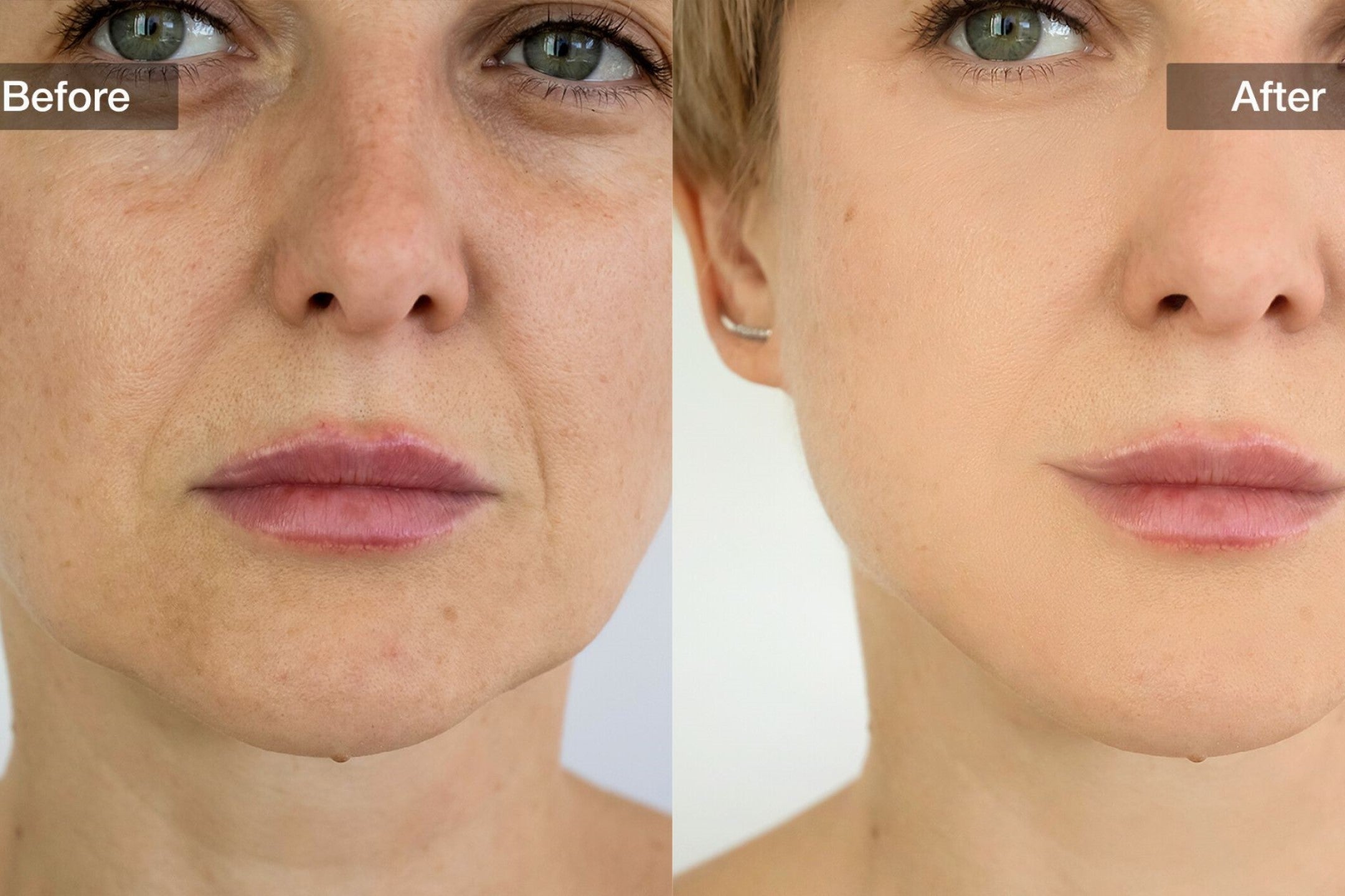 Face Red Light Therapy Before and After