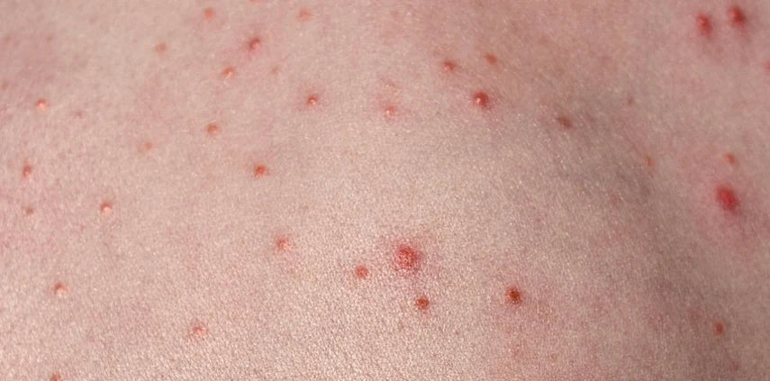 Post-Laser Hair Removal Folliculitis: Everything You Need to Know