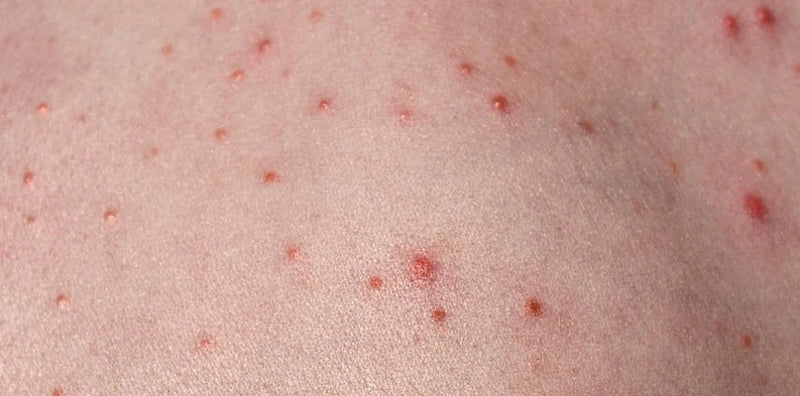 Post-Laser Hair Removal Folliculitis: Everything You Need to Know