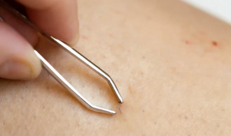 Ultimate Guide to Ingrown Hairs: What it is, Causes, and Treatment