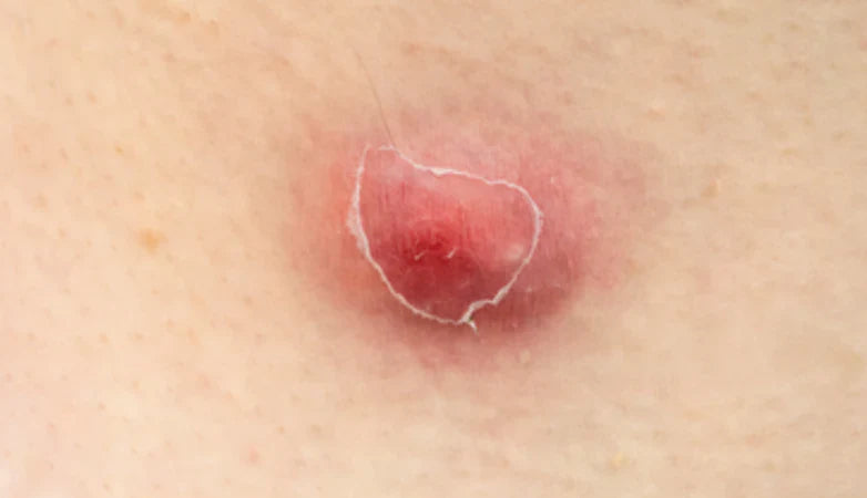 Know All Types of Red Bumps and How to Cure