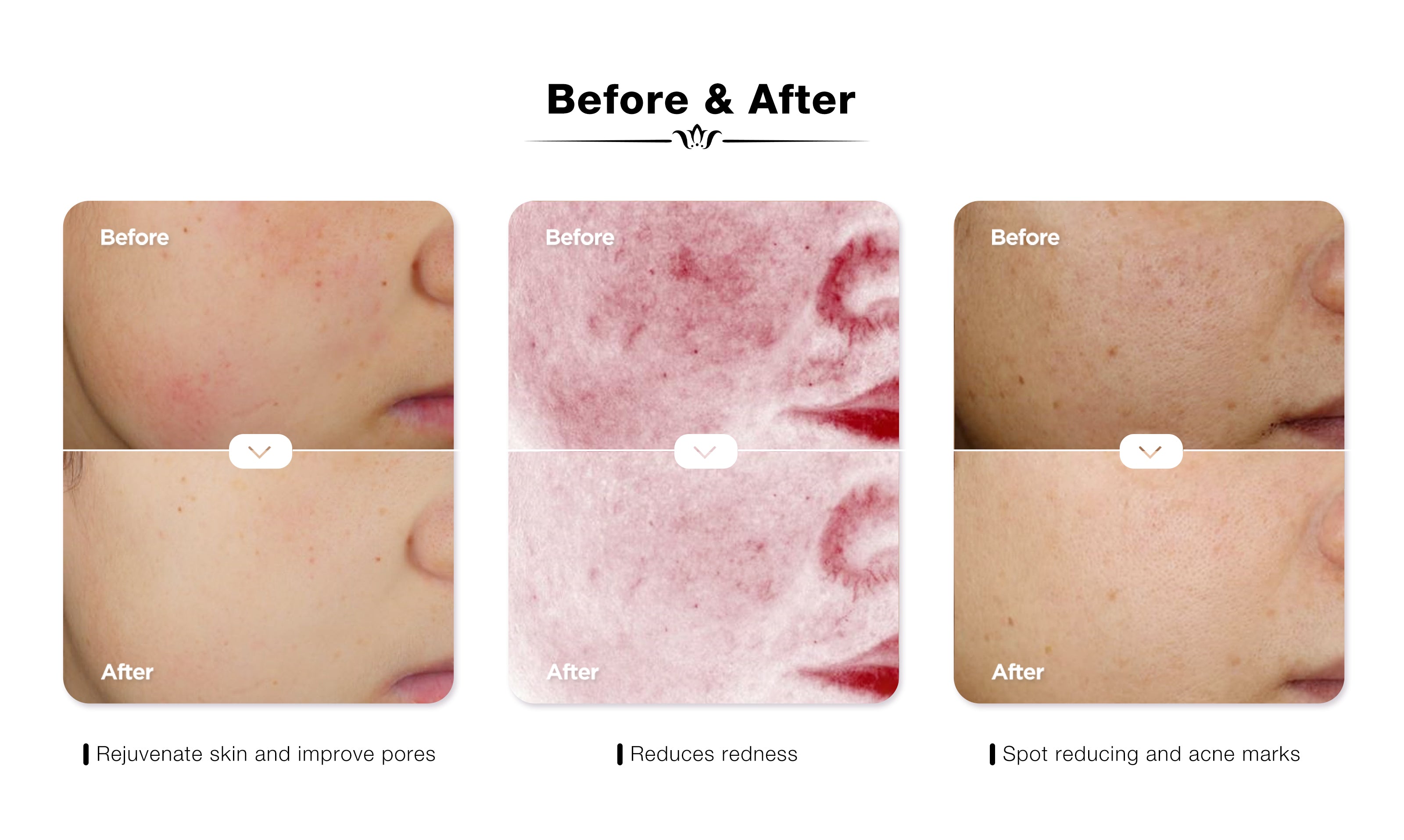 Before and after comparison images using JOVS Blacken PRO DPL Photorejuvenation Skincare Device: skin rejuvenation and pore improvement, redness reduction, and spots and acne marks fading.