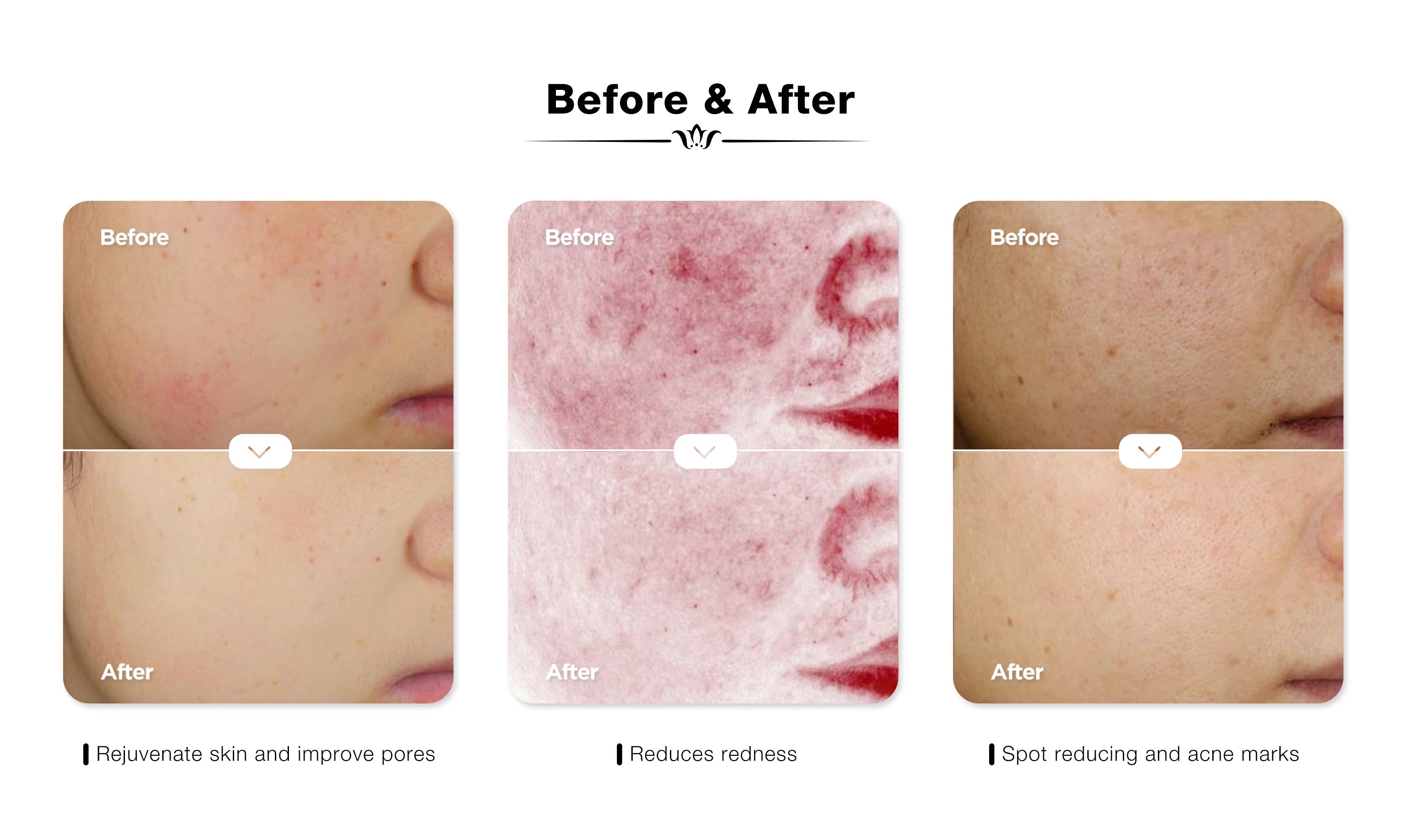 Before and after results using JOVS Blacken DPL Photorejuvenation Skincare Device showing rejuvenated skin, reduced redness, and diminished acne marks.