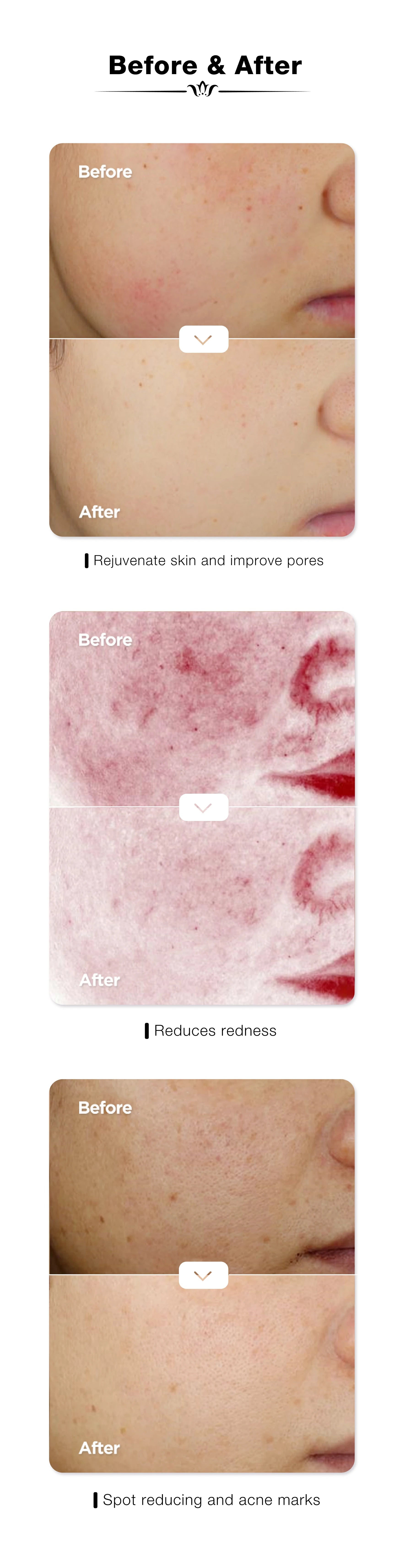Vertical before and after images illustrating skin rejuvenation, redness reduction, and spot treatment with JOVS Blacken DPL Photorejuvenation Device.