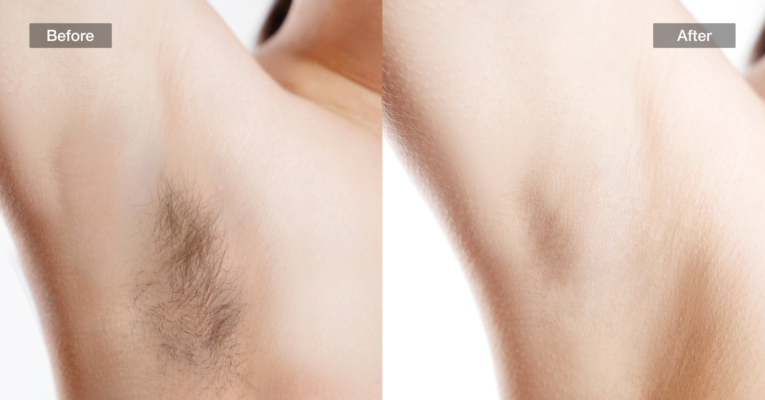 Visible results of underarm hair removal with JOVS Venus Pro II IPL technology.