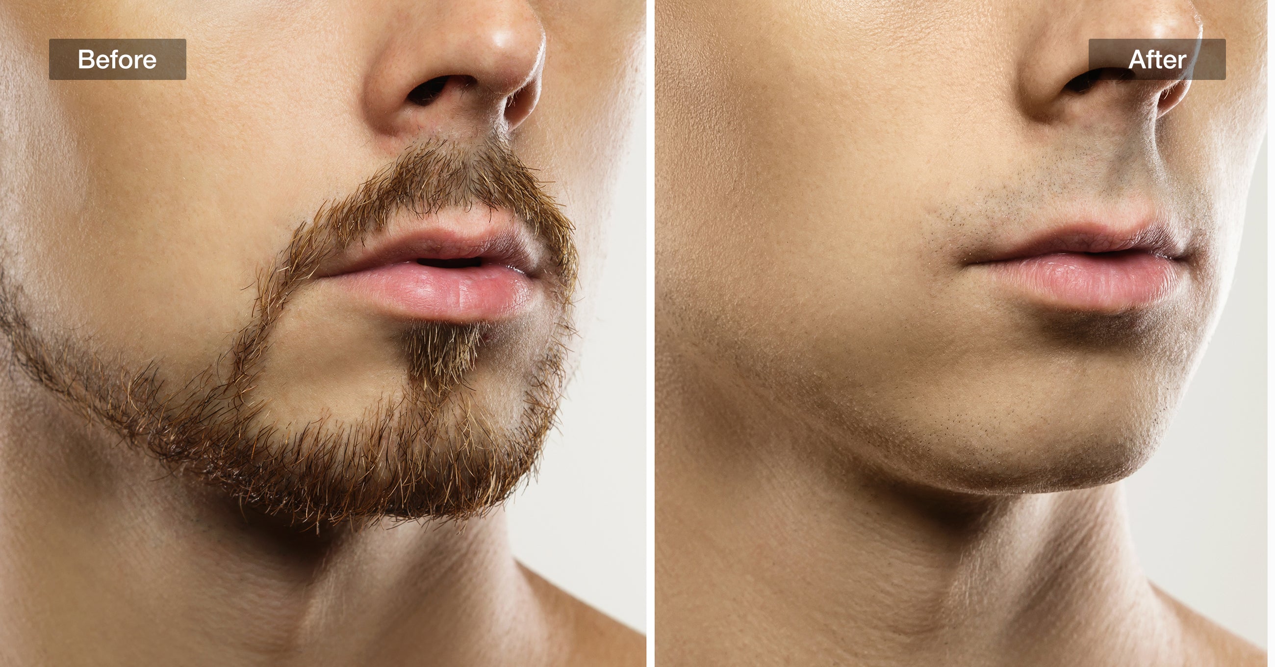 Facial hair refinement is visible before and after treatment with JOVS Venus Pro II IPL device.