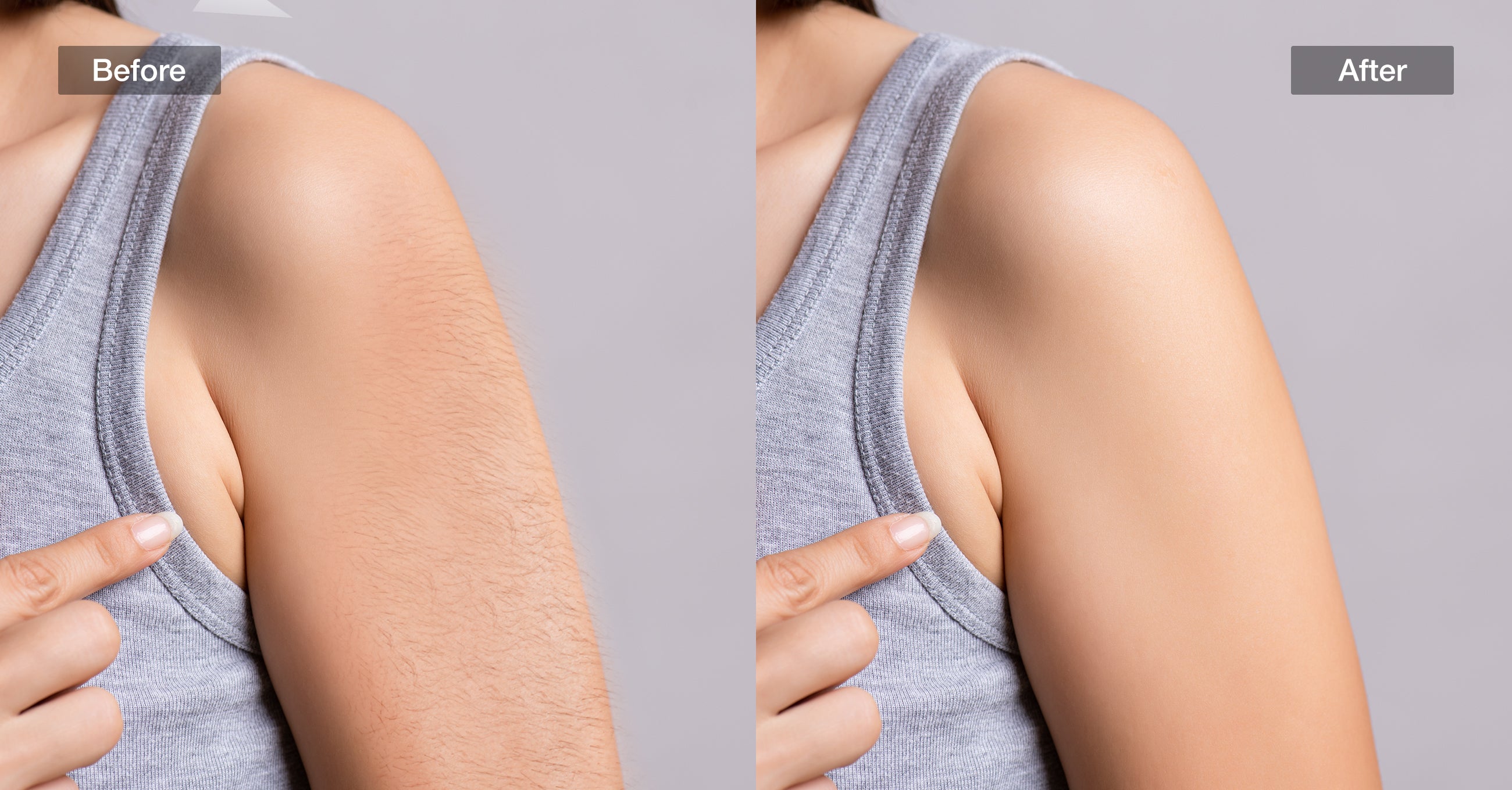 Comparison of arm hair reduction before and after using JOVS Venus Pro II IPL device at home.