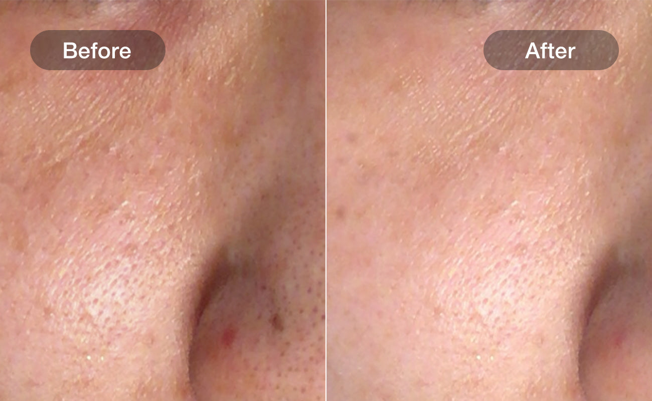 Dark Spot Reduction results