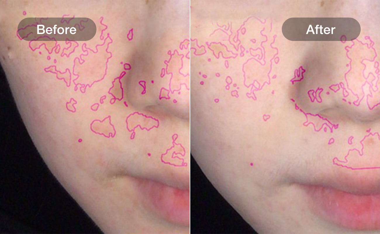 Acne and Blemish Control results