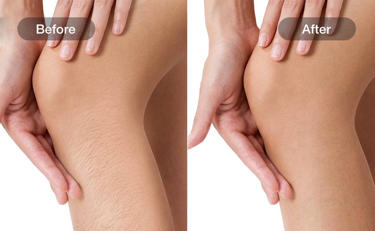 Legs hair removal results