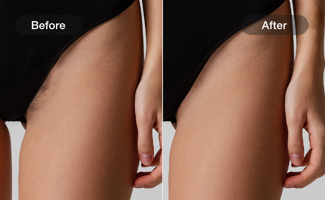 Bikini Area hair removal results