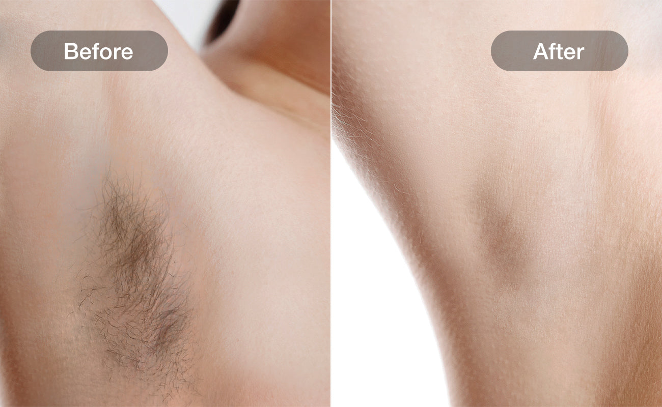 Underarms hair removal results