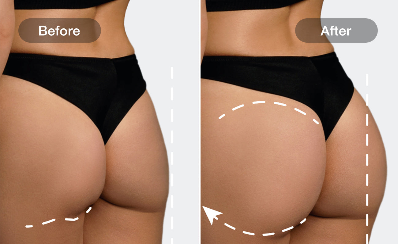 Lift and Sculpt results