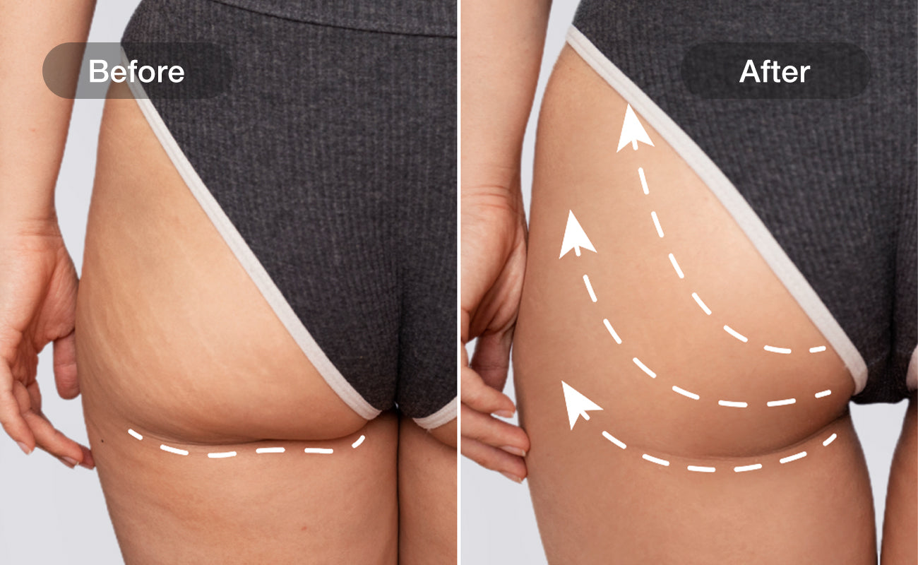 Bye Cellulite results