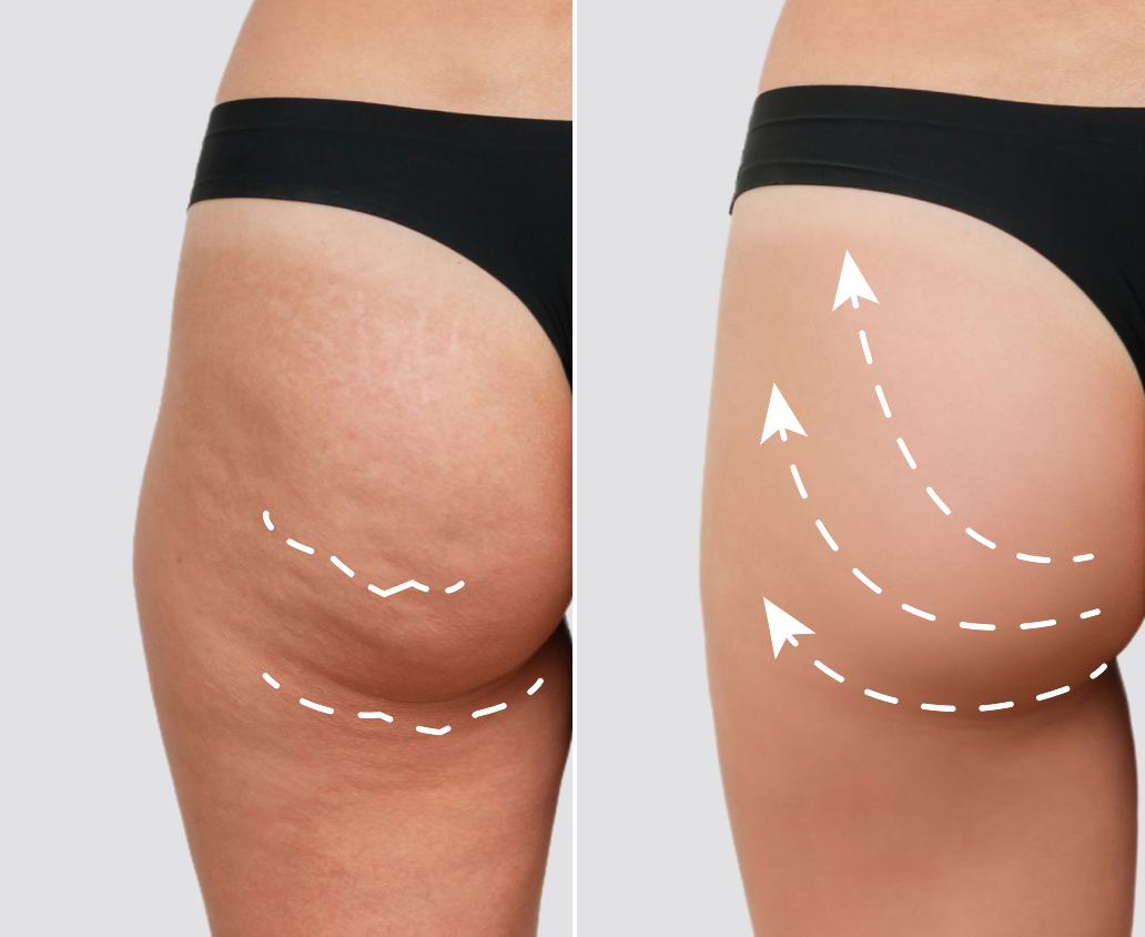 Bye Cellulite