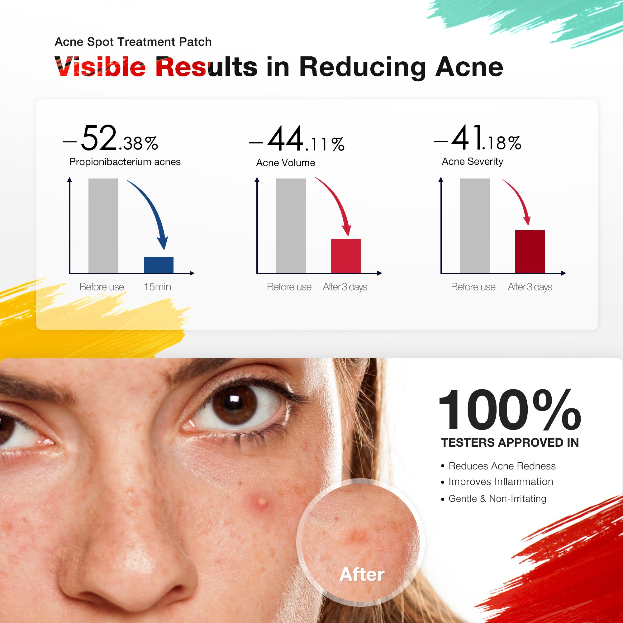 JOVS Acnebye LED Therapy Patch results showing significant reduction in acne severity and volume.