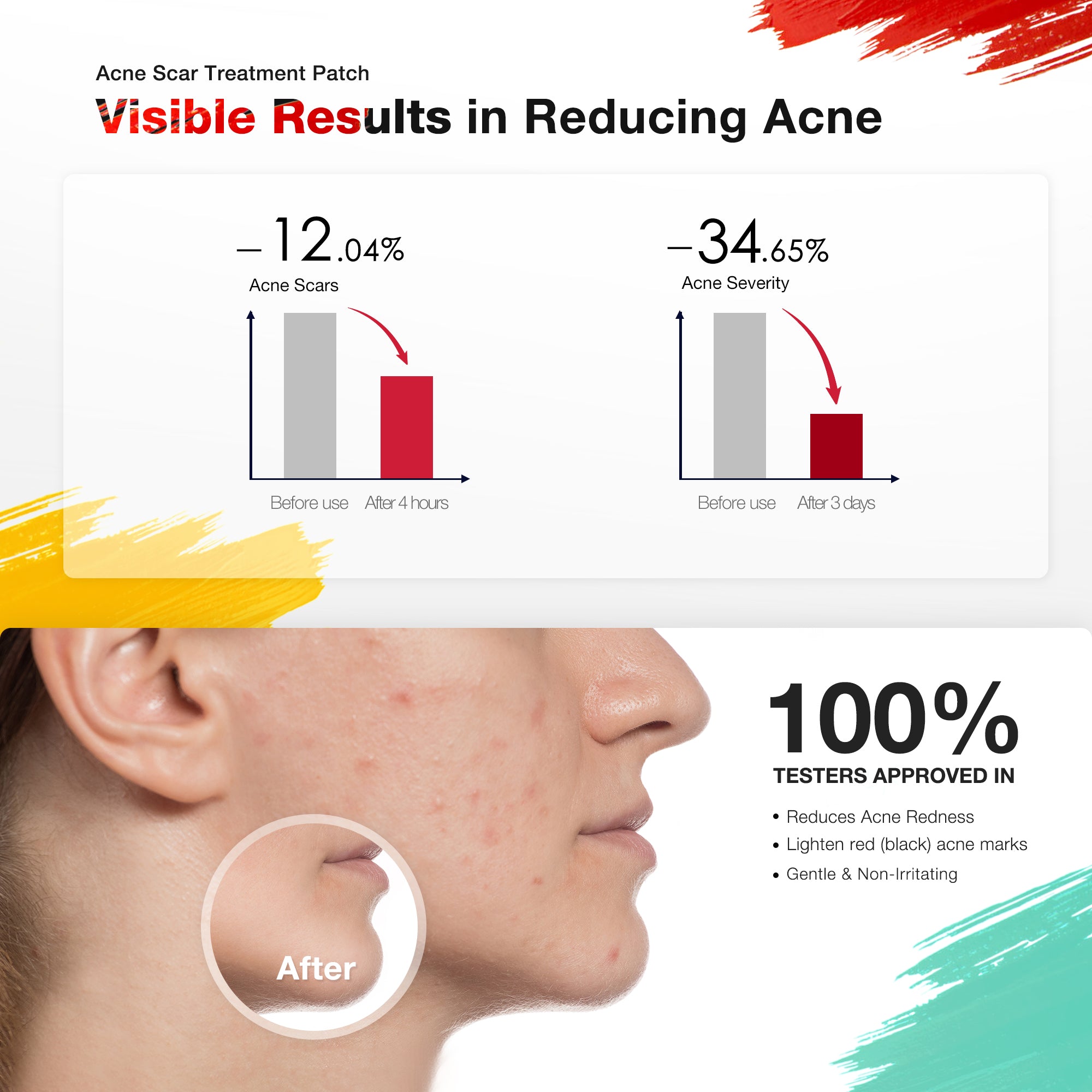 Visible results with JOVS Acnebye LED Therapy Patch in reducing acne and scars with before and after comparison.