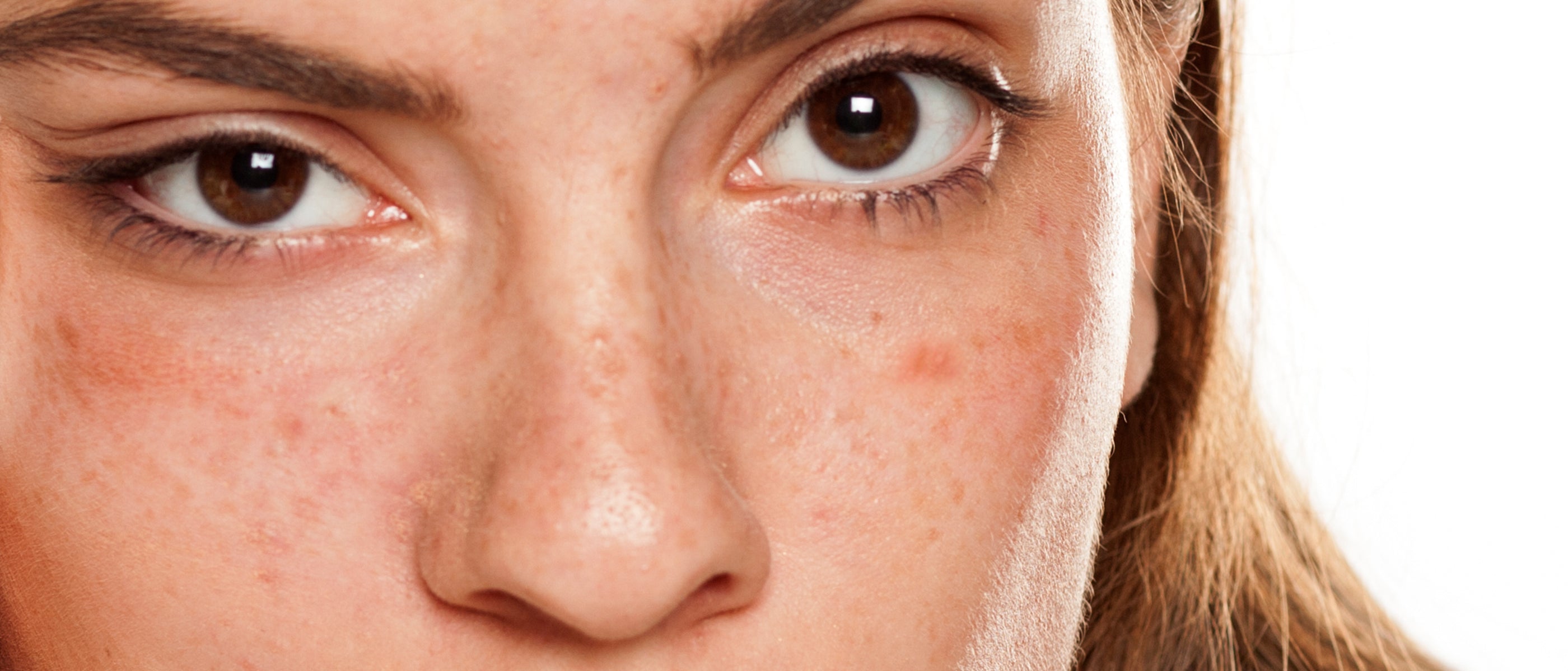 Close-up of woman face showing improvement in acne after using JOVS LED therapy patches.