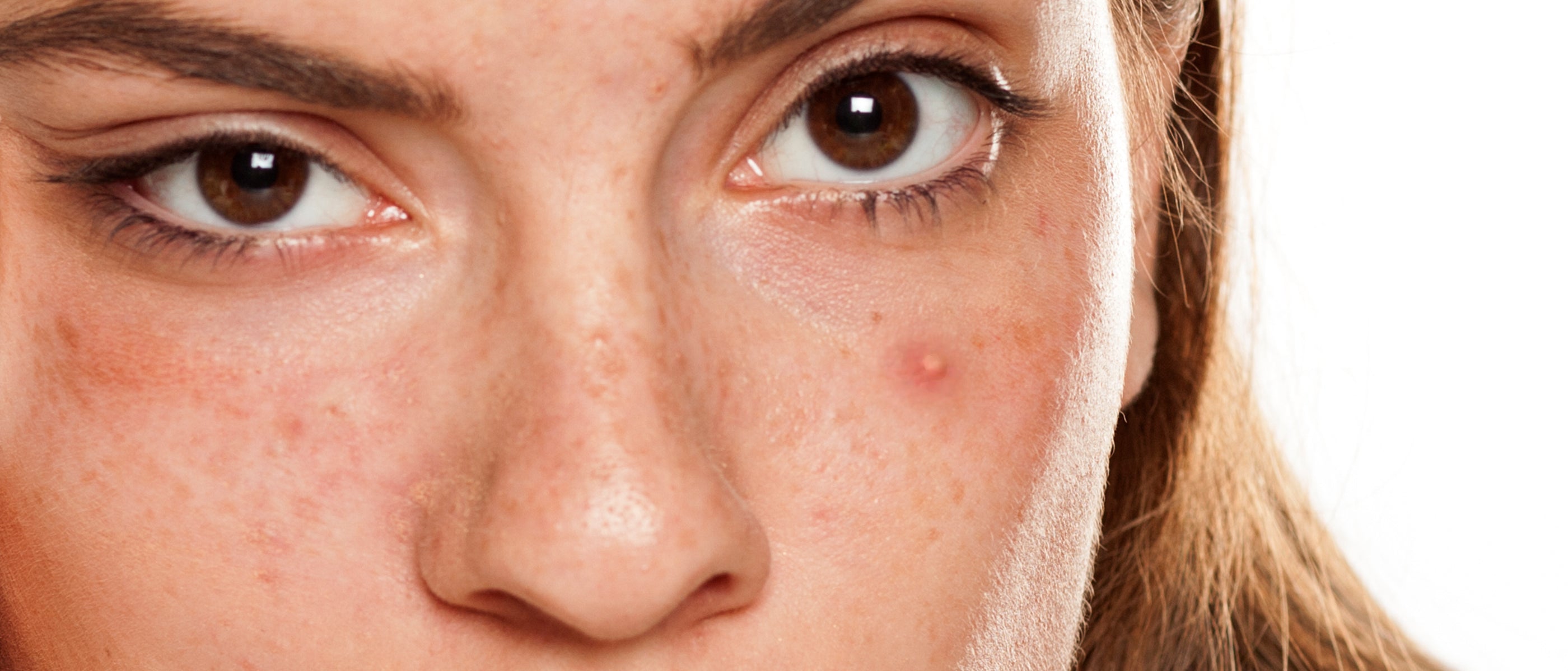 Close-up of woman face showing acne before using JOVS LED therapy patches.