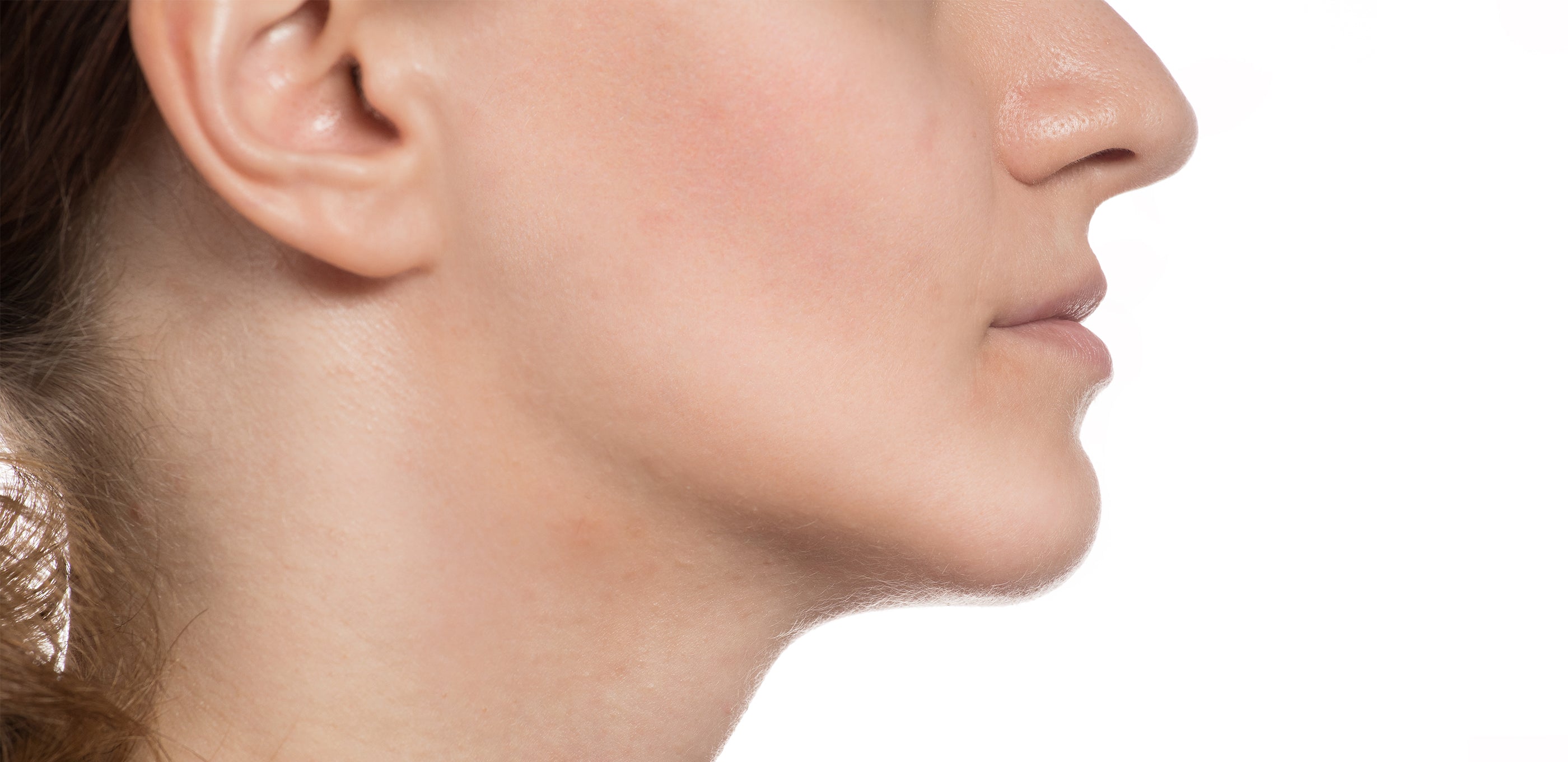 Side profile of a woman's face showing visible improvement in acne after using JOVS LED therapy patches.
