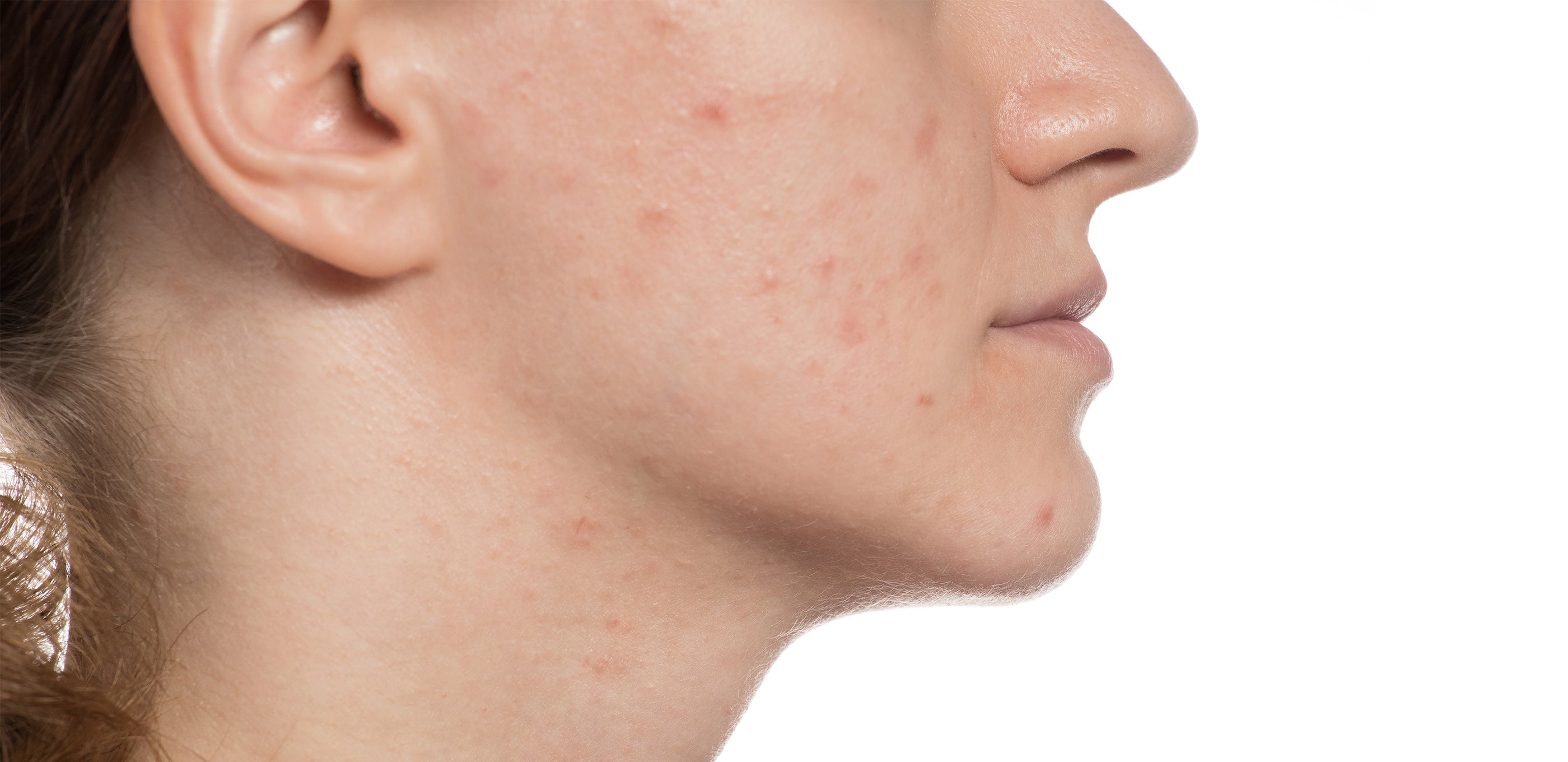 Side view of woman face with visible acne marks before using JOVS LED therapy patches.