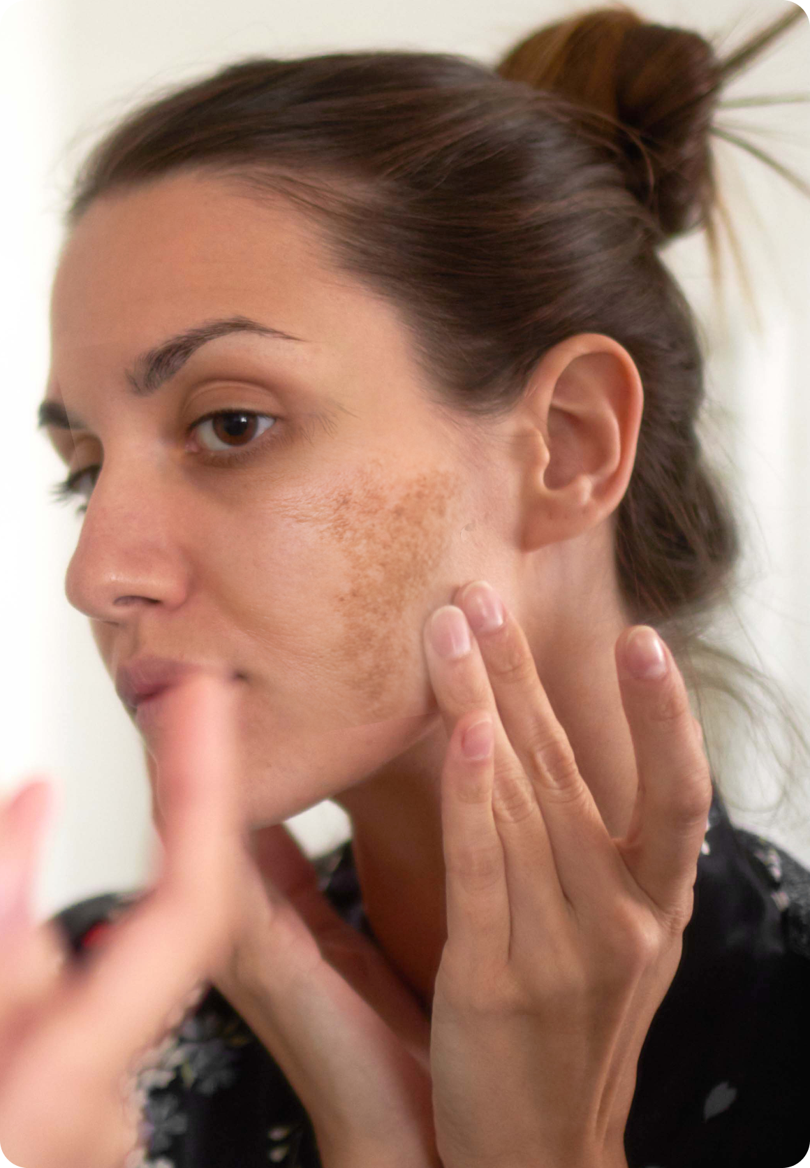 Hyperpigmentation