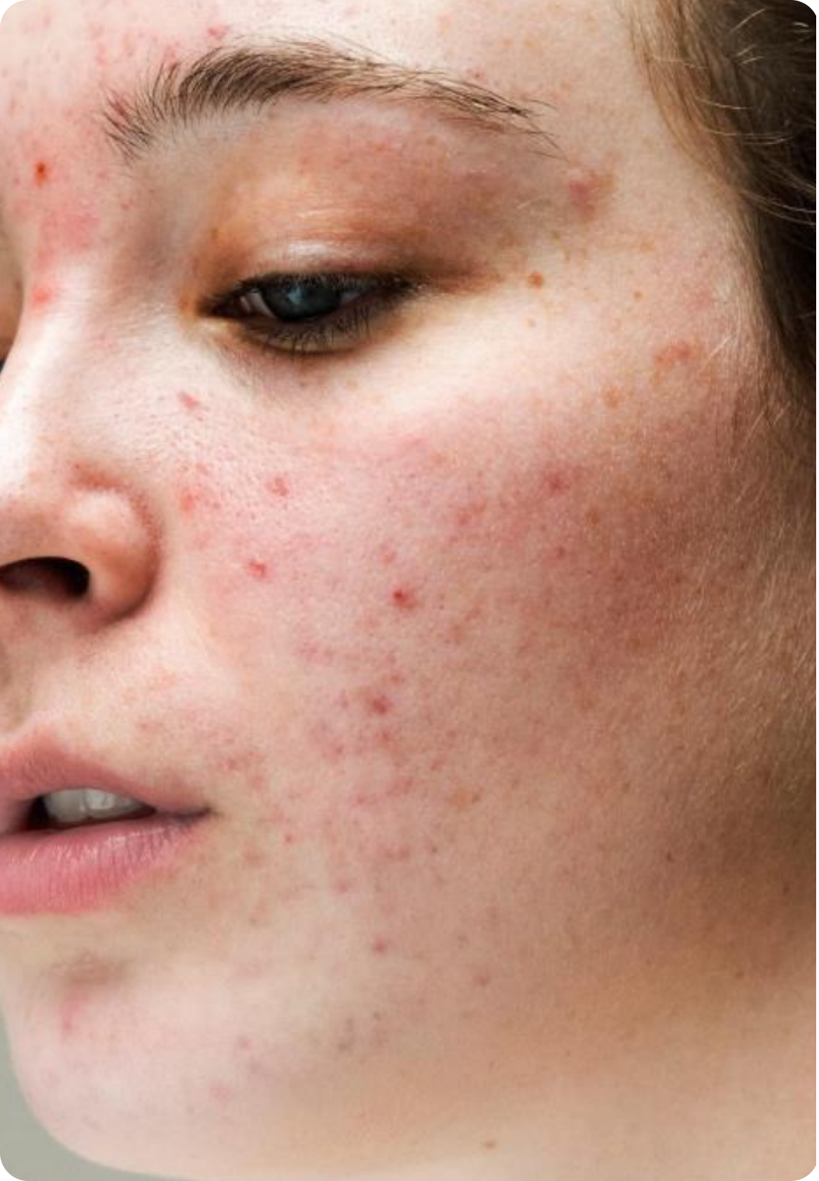 Acne & Spots