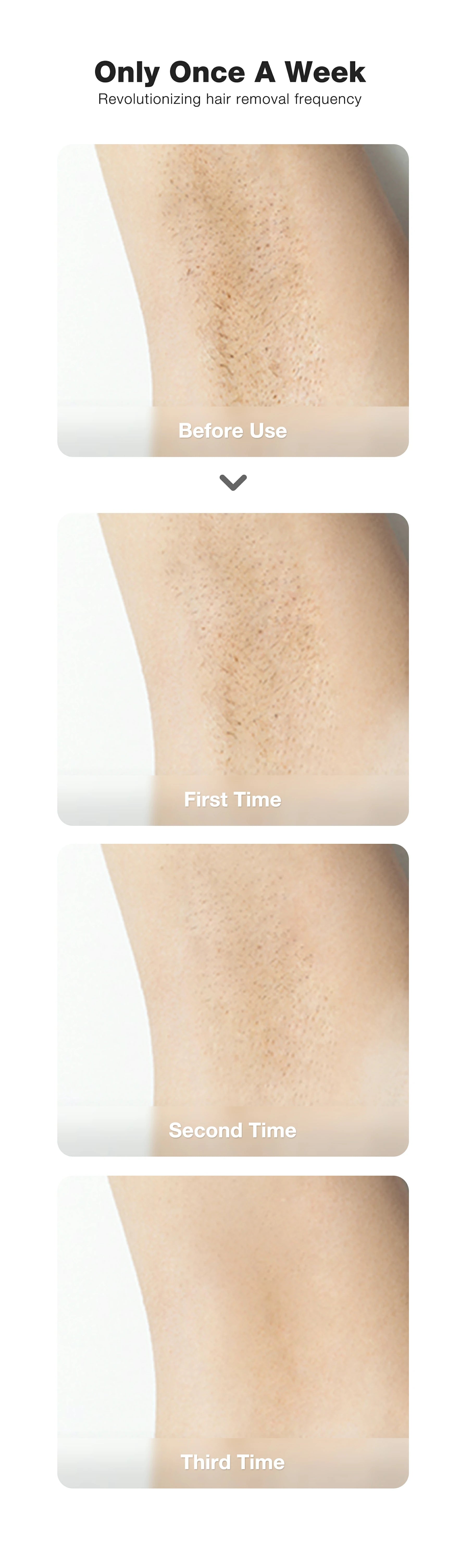 Progressive results of using JOVS X™ Hair Removal Device, showing hair density from before use, after the first, second, and third sessions.