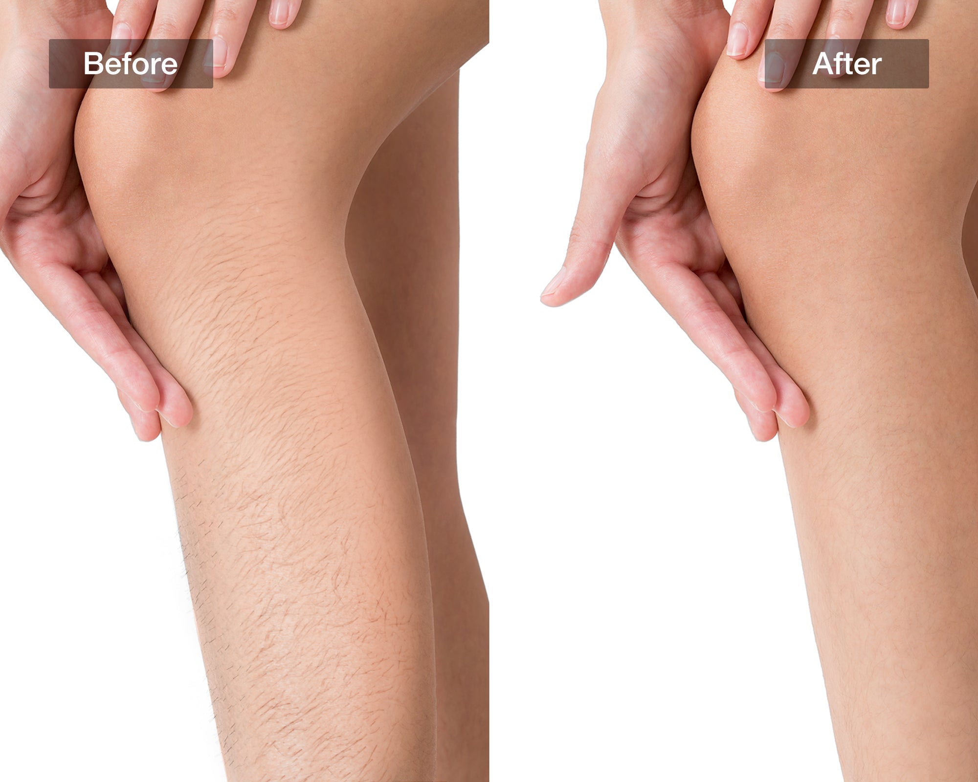 JOVS Venus Pro II IPL Device for At-Home Hair Removal
