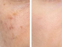 Dark Spots