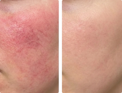 Reduce Redness
