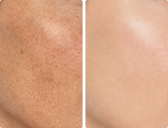 Skin Rejuvenation
