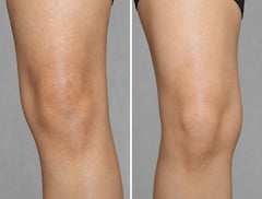 Dark Spot Reduction