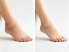 Foot Swelling