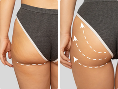 Glute Sagging