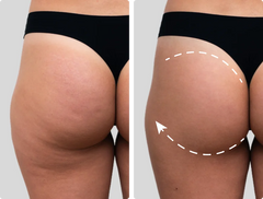Stubborn Cellulite