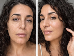 Facial Lifting